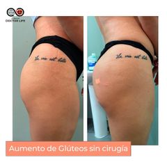 Aumento de glúteos - Clínicas Doctor Life