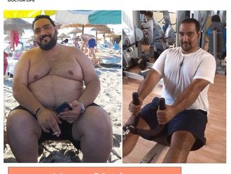 Manga gástrica antes y después - 854115