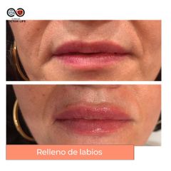 Aumento de labios - Clínicas Doctor Life