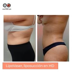 Liposucción - Clínicas Doctor Life