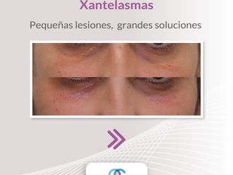 Xantelasmas antes y después - 861757