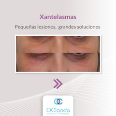 Xantelasmas - Dra. Luz María Vásquez González