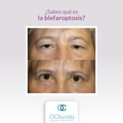 Blefaroplastia - Dra. Luz María Vásquez González