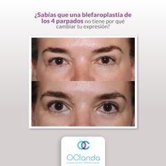 Blefaroplastia - Dra. Luz María Vásquez González