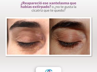 Xantelasmas antes y después - 861760