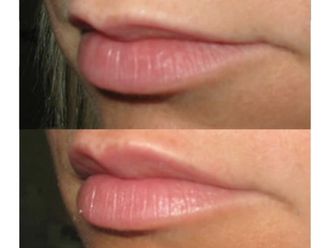Aumento labios - 501718