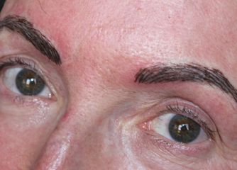 Alopecia cejas después de micropigmentación