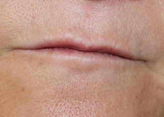 Antes del tratamiento de micropigmentación. Labios finos y despigmentados. 