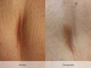 Antes y después Cicatríz tras una mastectomia zona lateral debajo axila