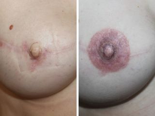 Antes y después Micropigmentación de areola