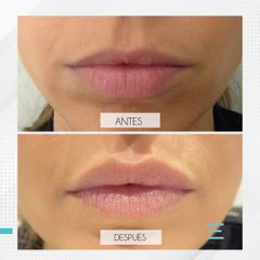 Aumento de labios - Clínica IEMEC