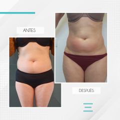 Mesoterapia - Clínica IEMEC
