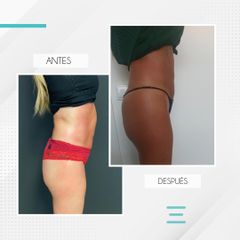 Mesoterapia - Clínica IEMEC