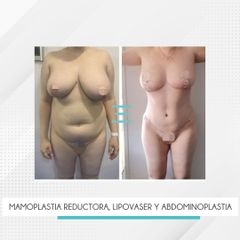 Lipoescultura - Clínica IEMEC
