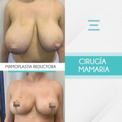 Reducción de senos - Clínica IEMEC