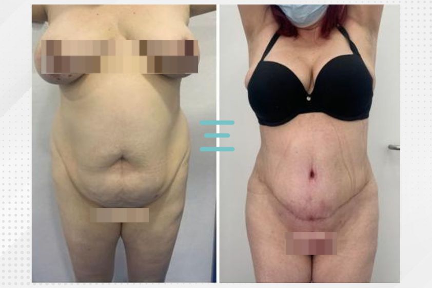 Lipo Vaser antes y después - 830418