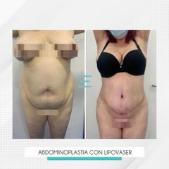 Abdominoplastia con Lipovaser - Clínica IEMEC