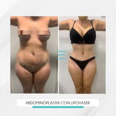Abdominoplastia con Lipovaser - Clínica IEMEC