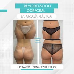 Lipovaser - Clínica IEMEC