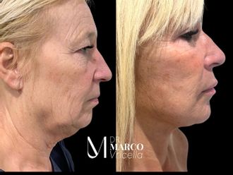 Blefaroplastia antes y después - 880168