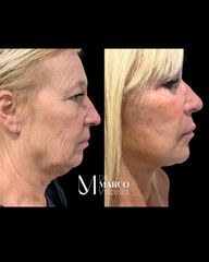 Lifting de Cara y Cuello + Blefaroplastia Completa