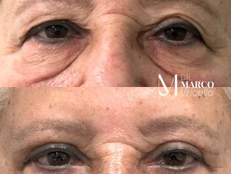 Blefaroplastia antes y después - 880172
