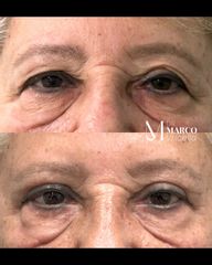 Blefaroplastia - Clínica IEMEC