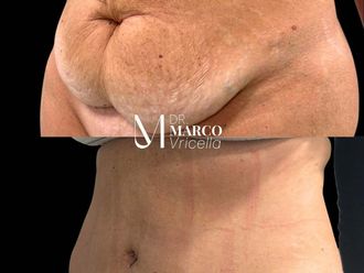 Abdominoplastia antes y después - 880173