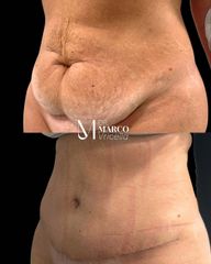 Abdominoplastia - Clínica IEMEC