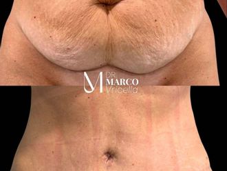 Abdominoplastia antes y después - 880174