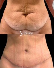 Abdominoplastia - Clínica IEMEC