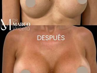 Aumento de pecho antes y después - 880254