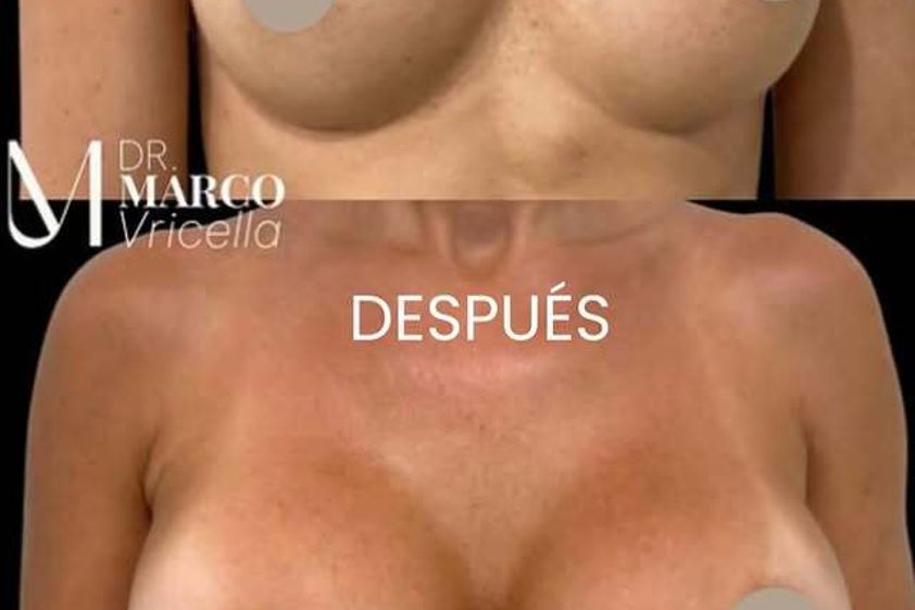 Aumento de pecho antes y después - 880254