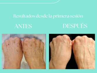 Eliminación arrugas antes y después - 880255