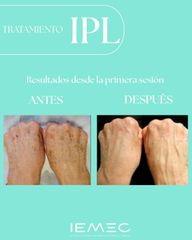 Tratamiento IPL - Clínica IEMEC