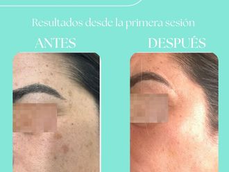 Eliminación arrugas antes y después - 880256