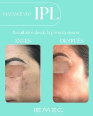 Tratamiento IPL - Clínica IEMEC