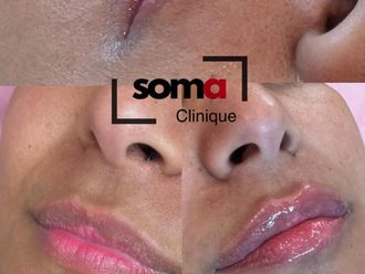 Aumento labios antes y después - 875932