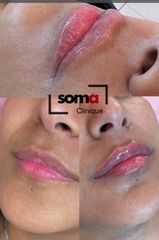 Somaclinique - Labios