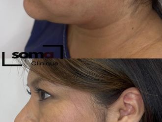 Liposucción de papada antes y después - 875933