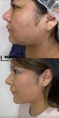 Somaclinique - Lipomodelación papada y tercio inferior.
