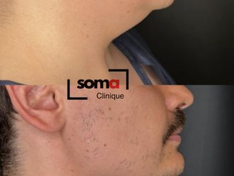 Liposucción de papada antes y después - 875934