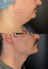 Somaclinique - Lipomodelación papada