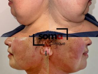 Liposucción de papada antes y después - 875935