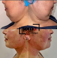 Somaclinique - Lipomodelación papada