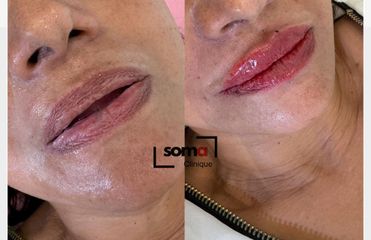 Somaclinique - Labios