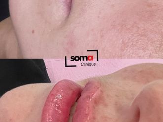 Aumento labios antes y después - 875938