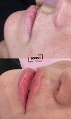 Somaclinique - Labios