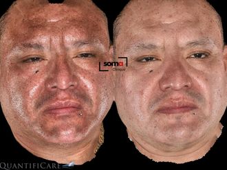 Tratamiento antimanchas antes y después - 875940