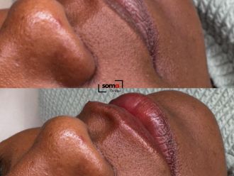 Aumento labios antes y después - 875948